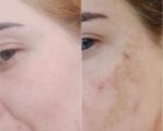 Expigment Crème Hydroquinone 4% 30g